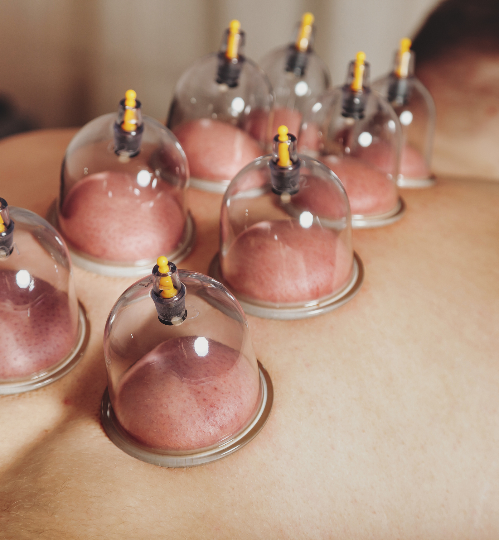 Dry cupping